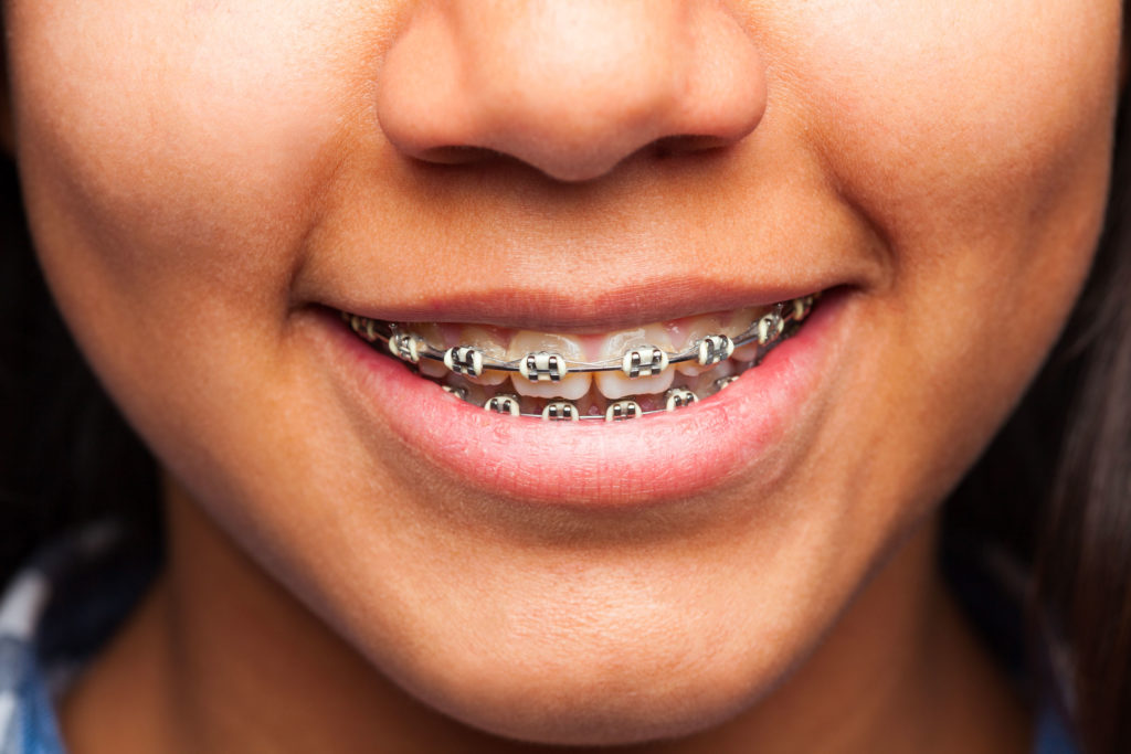 Orthodontie enfant 2-centre dentaire lancy
