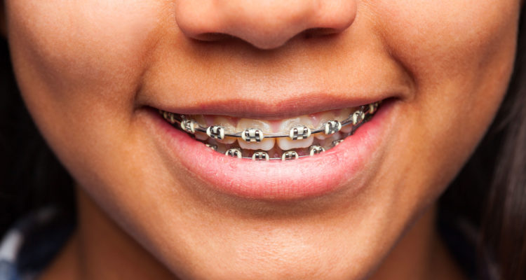 Orthodontie enfant 2-centre dentaire lancy