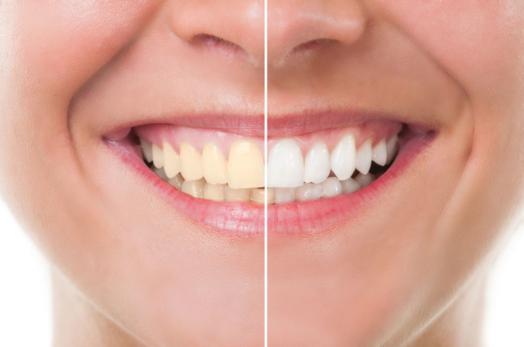 Centre dentaire Lancy - Dental whitening
