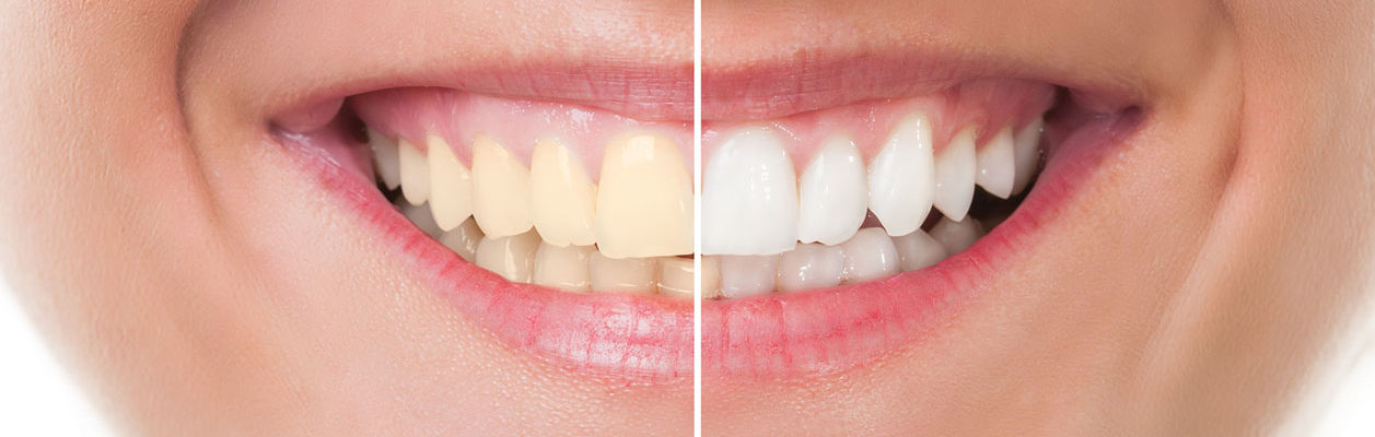 Centre dentaire Lancy - Dental whitening