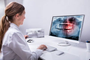 Center Dentaire Lancy - Wisdom teeth extraction