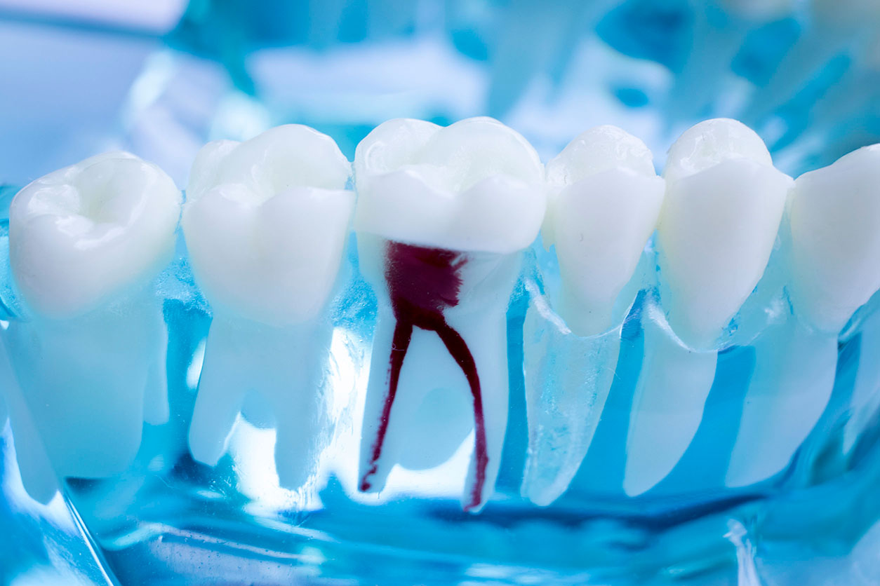 Центр стоматологии Ланси - Лечение корней зубов