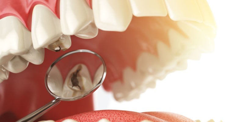 centre dentaire Lancy - Caries Dentaires