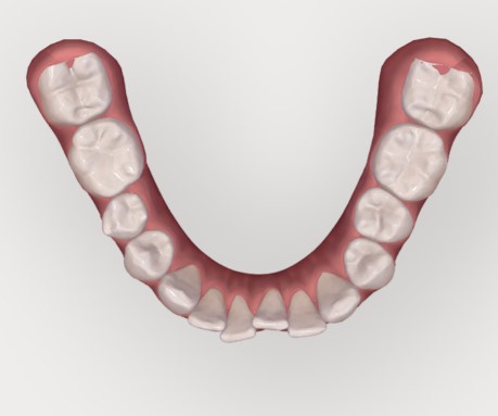 Invisalign, l'appareil dentaire invisible et amovible.