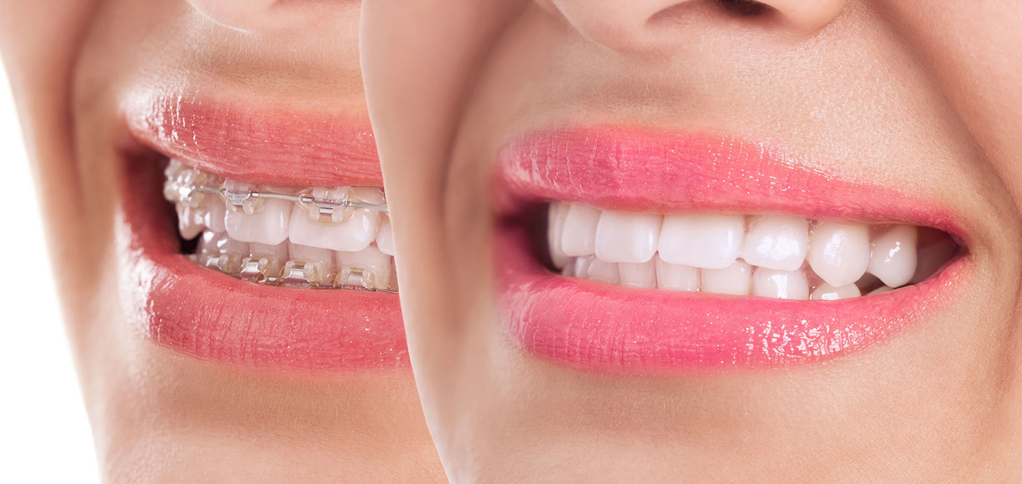 Orthodontic treatment in Geneva