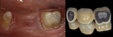 dental_reconstruction01-lancy