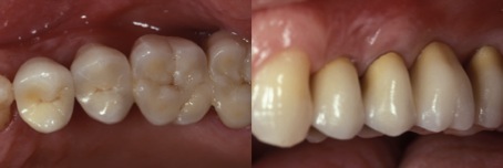 dental_rekonstruktion-lancy