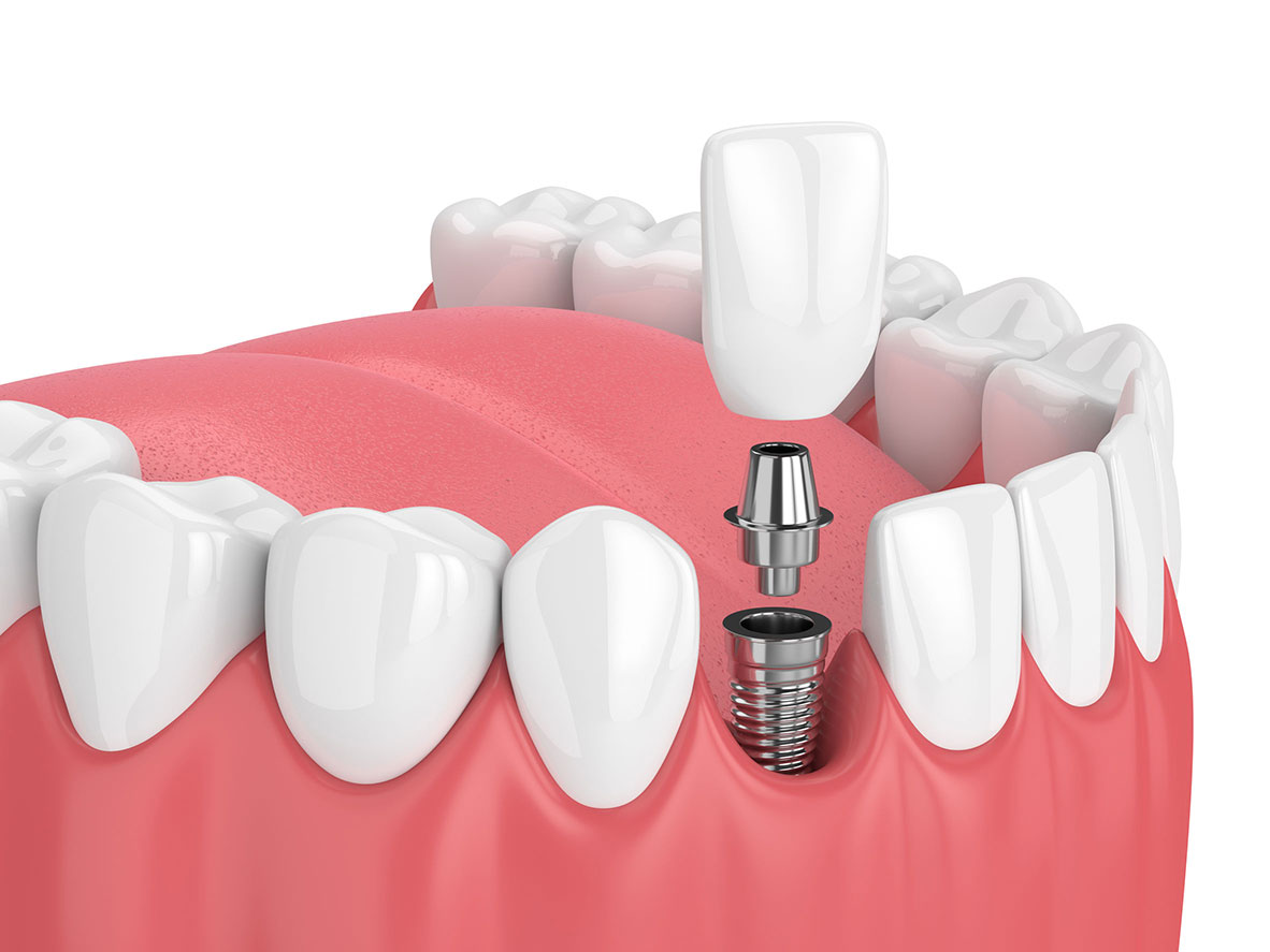 Centre dentaire Lancy - Implantes dentários
