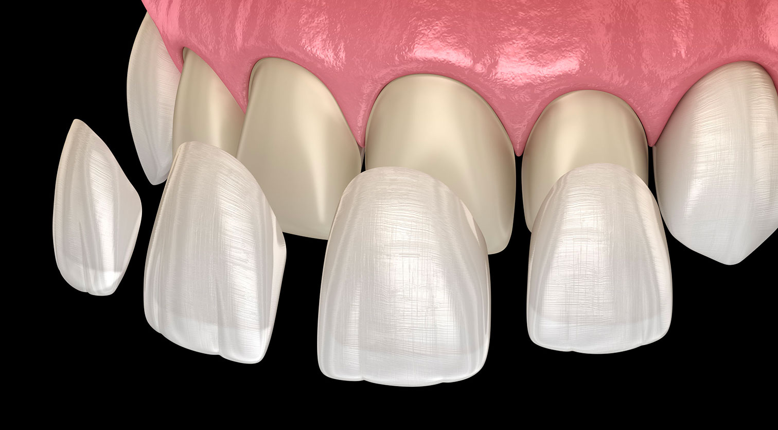 Lancy Dental Centre - Dental Veneers