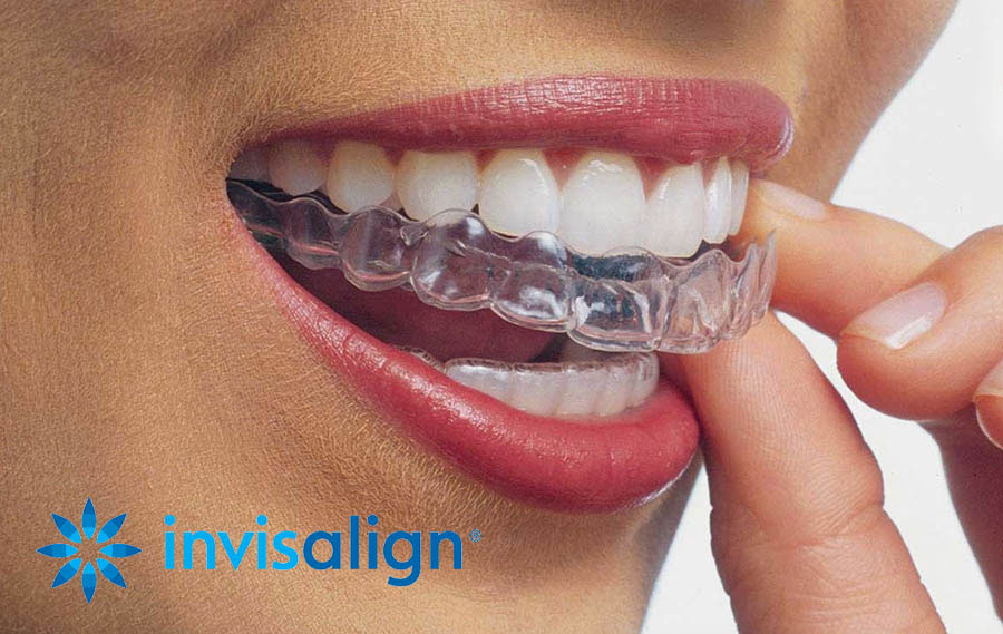 Centre dentaire Lancy - Alinhadores Invisalign®.