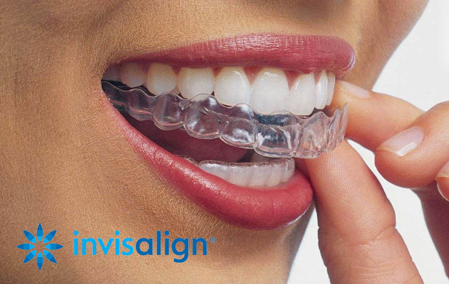 Les gouttières Invisalign® - Centre dentaire Lancy - Genève