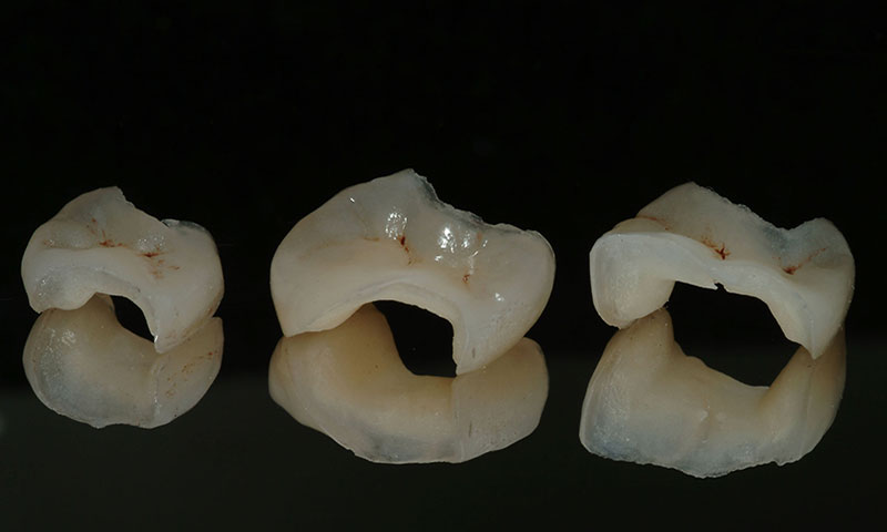 centro dental onlay