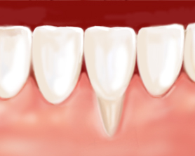 periodoncia - centro dental lancy