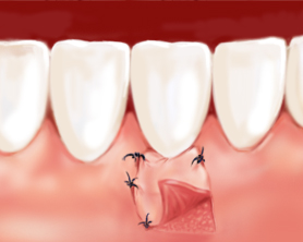 periodontología2-centro dental de lujo