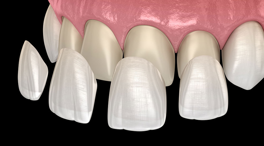 dental veneers Geneva