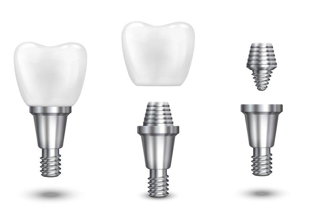 implantes dentales en Suiza