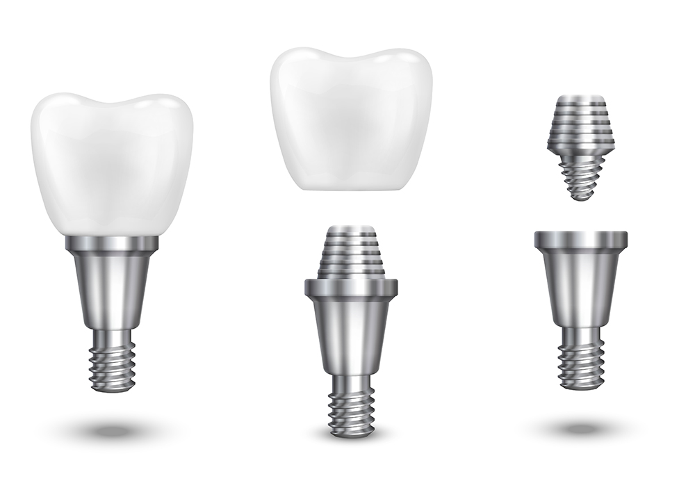 implante dentário na Suíça