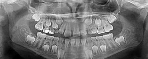 OPT-ENFANTS Radiographie panoramique enfant