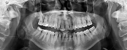 Radiographie Panoramique