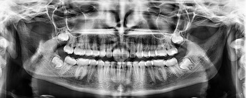 Radiographie panoramique enfant