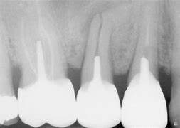 Perímetro apical