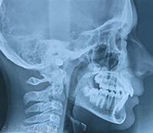 Profile teleradiography