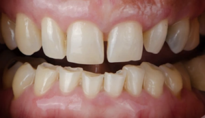 What are the possible complications of bruxism?