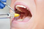 anesthésie dentaire