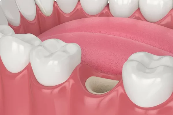 Greffe osseuse dentaire