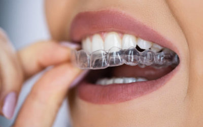 gouttière Invisalign