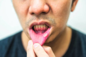 mouth ulcers remedies