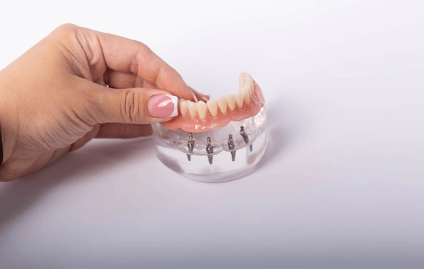 prothèses dentaires