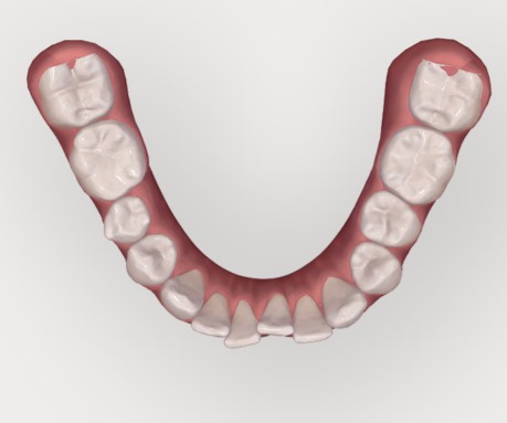 centre-dentaire-lancy-invisalign-1