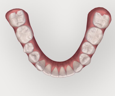 centre-dentaire-lancy-invisalign-2